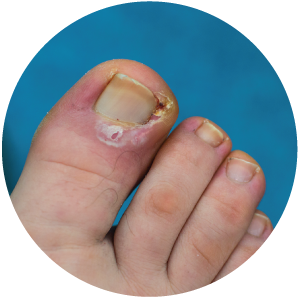 In Grown Toenail Solutions at Alpine Foot & Ankle
