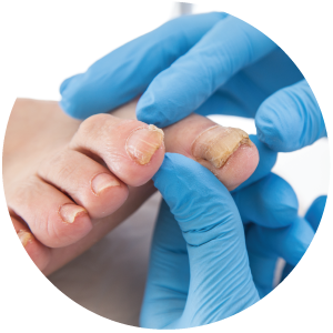 Toenail Pain - Learn more at Alpine Foot & Ankle